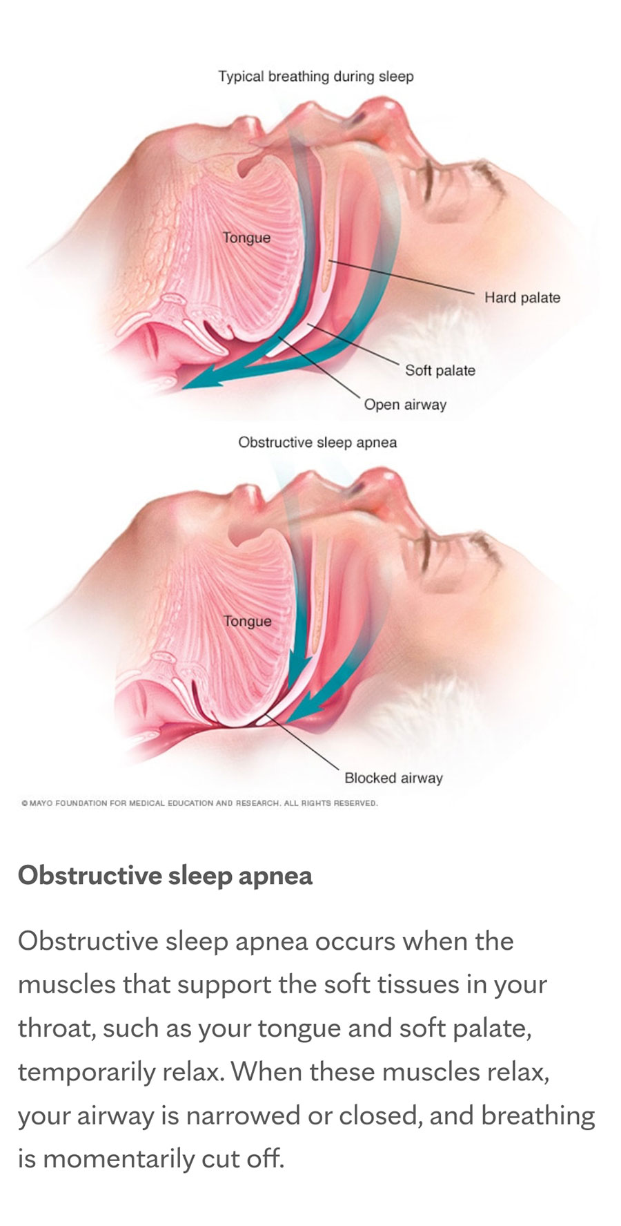 sleep apnea